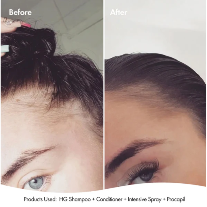 Bondi Boost HG Procapil Hair Tonic For Thinning Hair