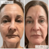 Omnilux Contour Face