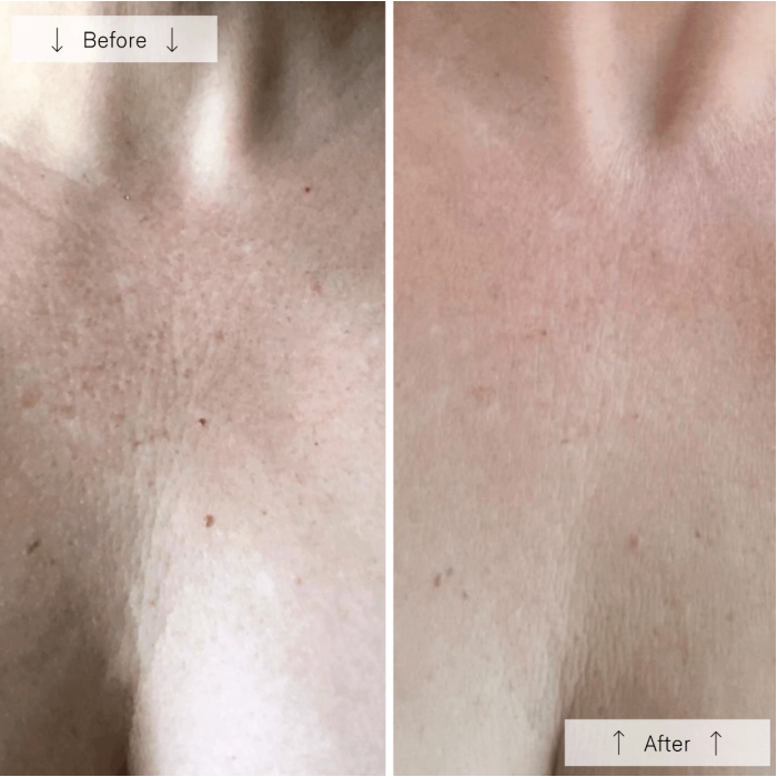 Omnilux Contour Neck & Décolleté