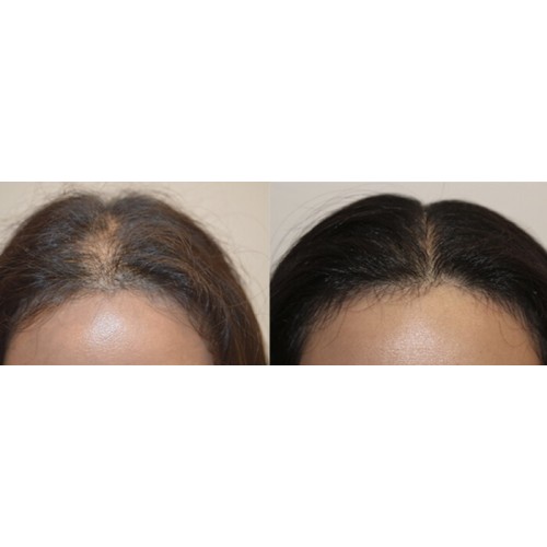 Evolis Professional Reverse 3-Step Hair Restoration System