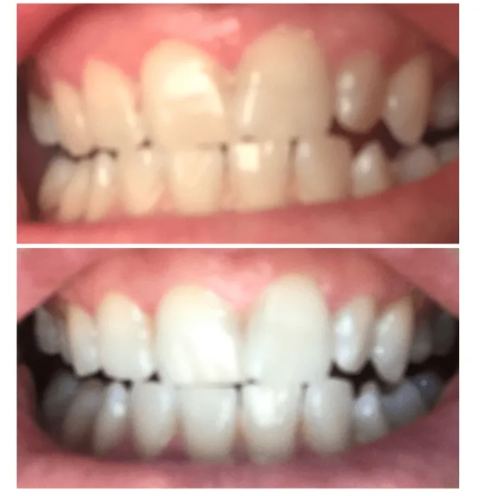 Benefit Whitening Professional 7 LED Teeth Whitening Kit Benefit Whitening Professional 7 LED Teeth Whitening Kit