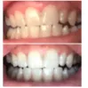 Benefit Whitening Professional 7 LED Teeth Whitening Kit Benefit Whitening Professional 7 LED Teeth Whitening Kit